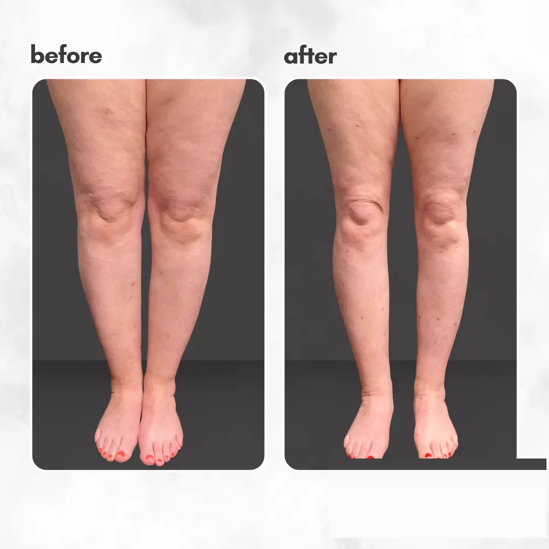 Lipedema before-and-after comparison.