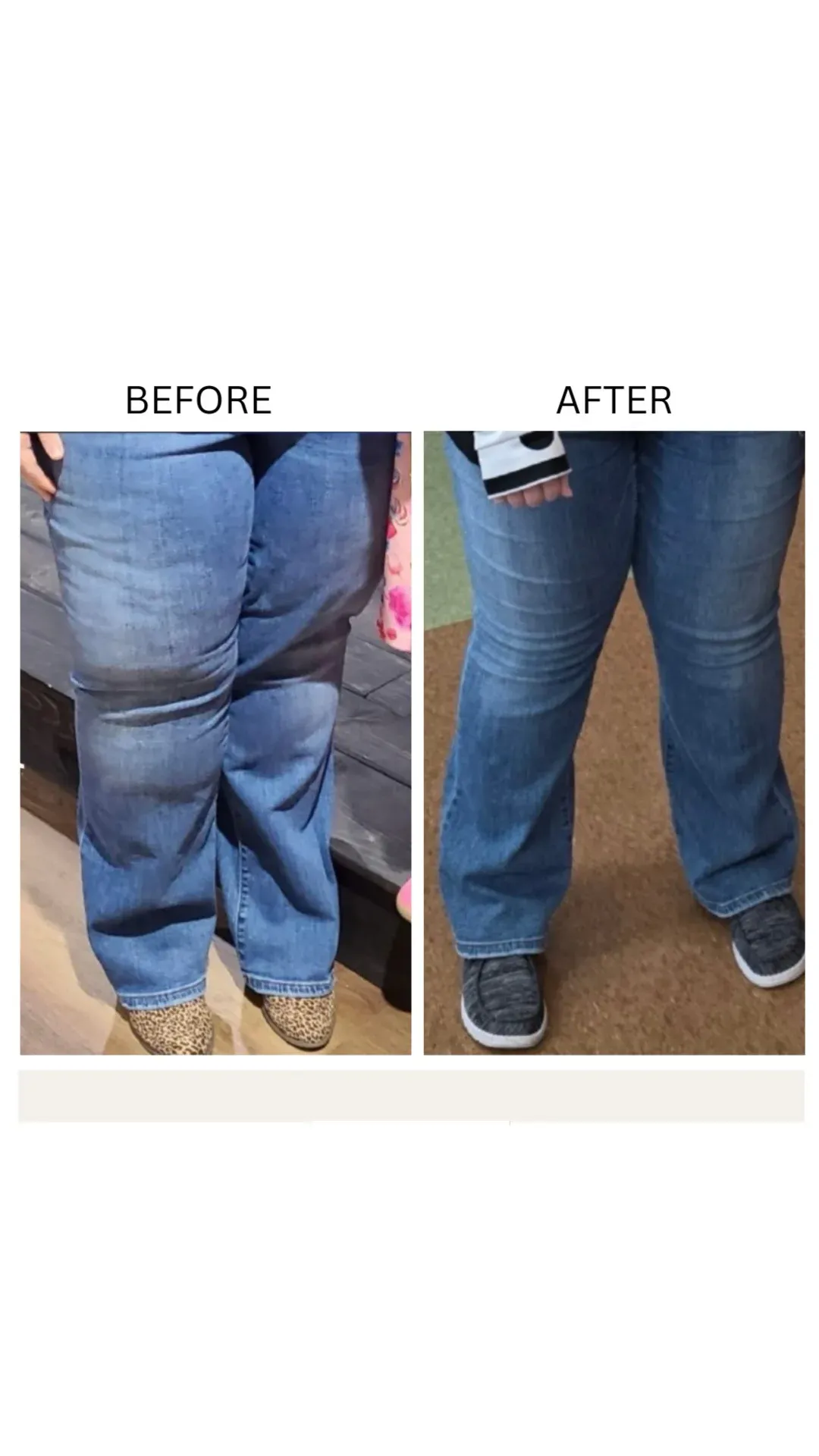 Lipedema before-and-after comparison.