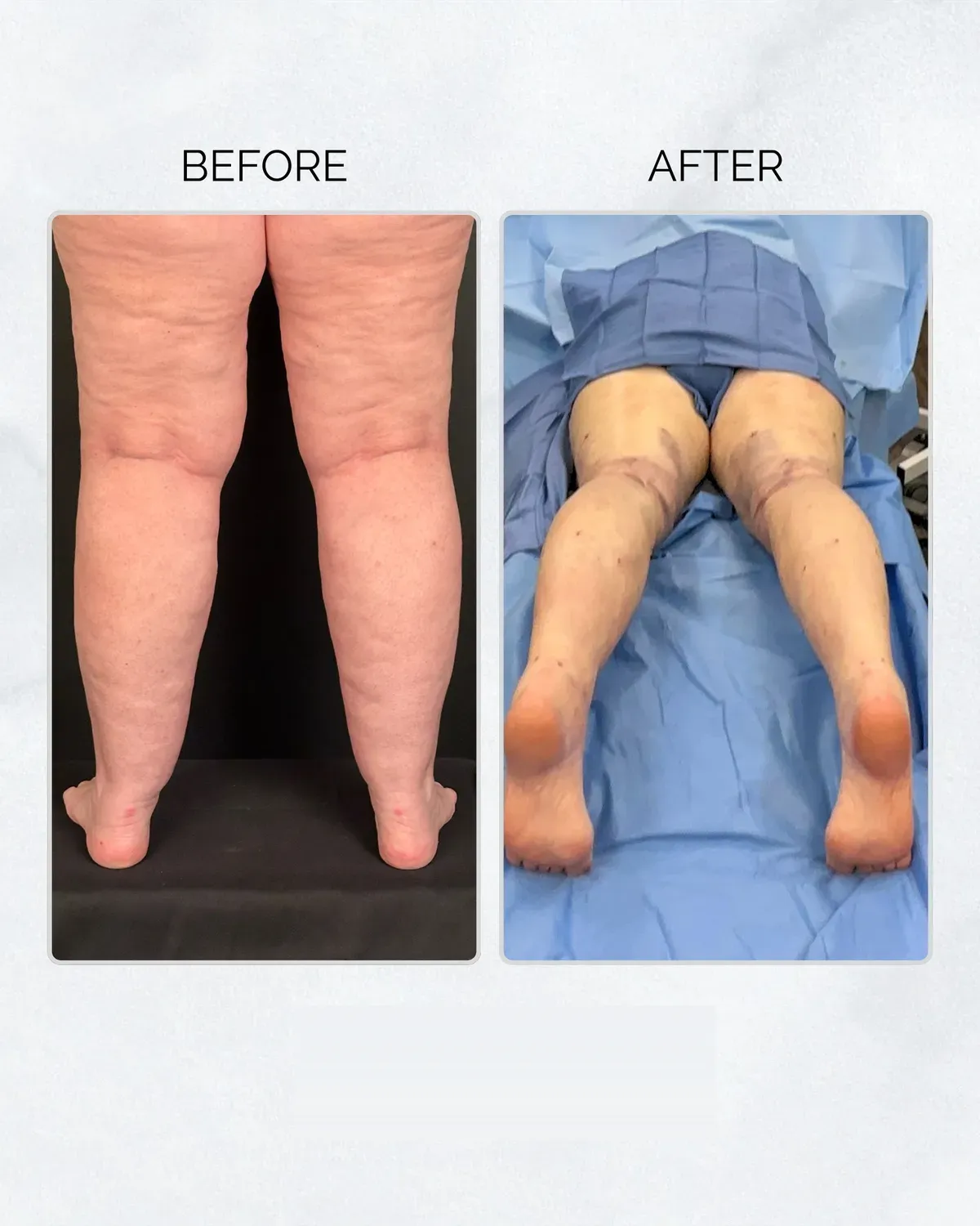 Lipedema before-and-after comparison.