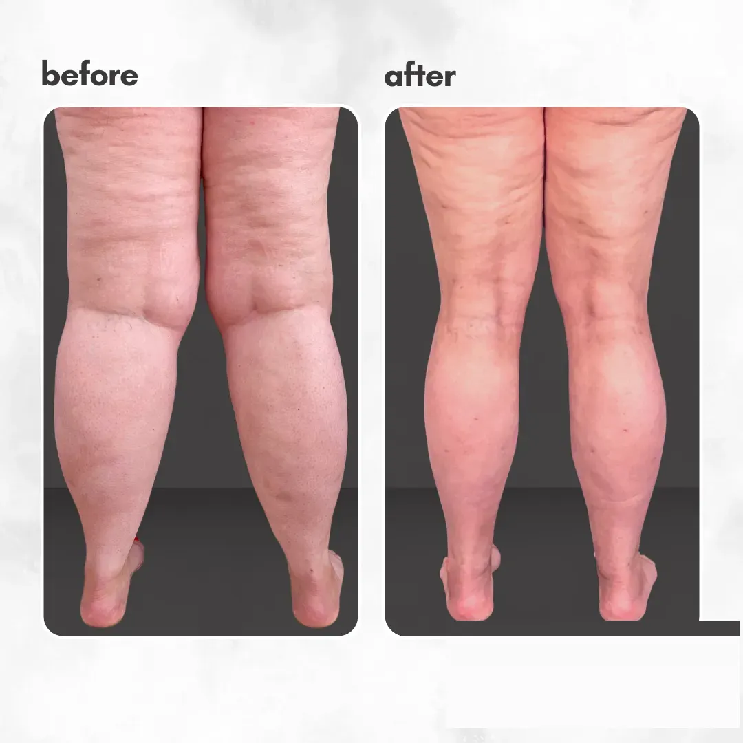 Lipedema before-and-after comparison.