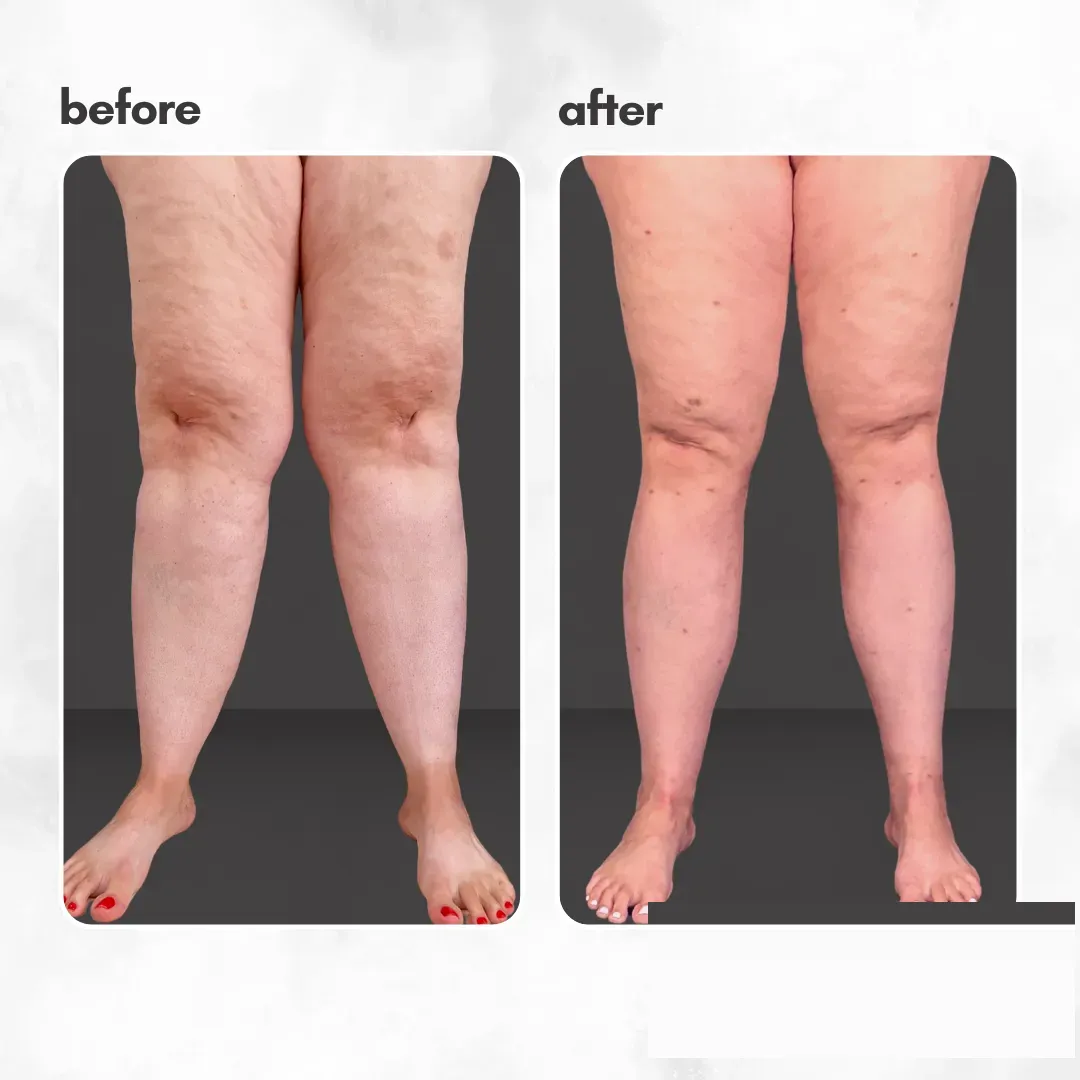 Lipedema before-and-after comparison.