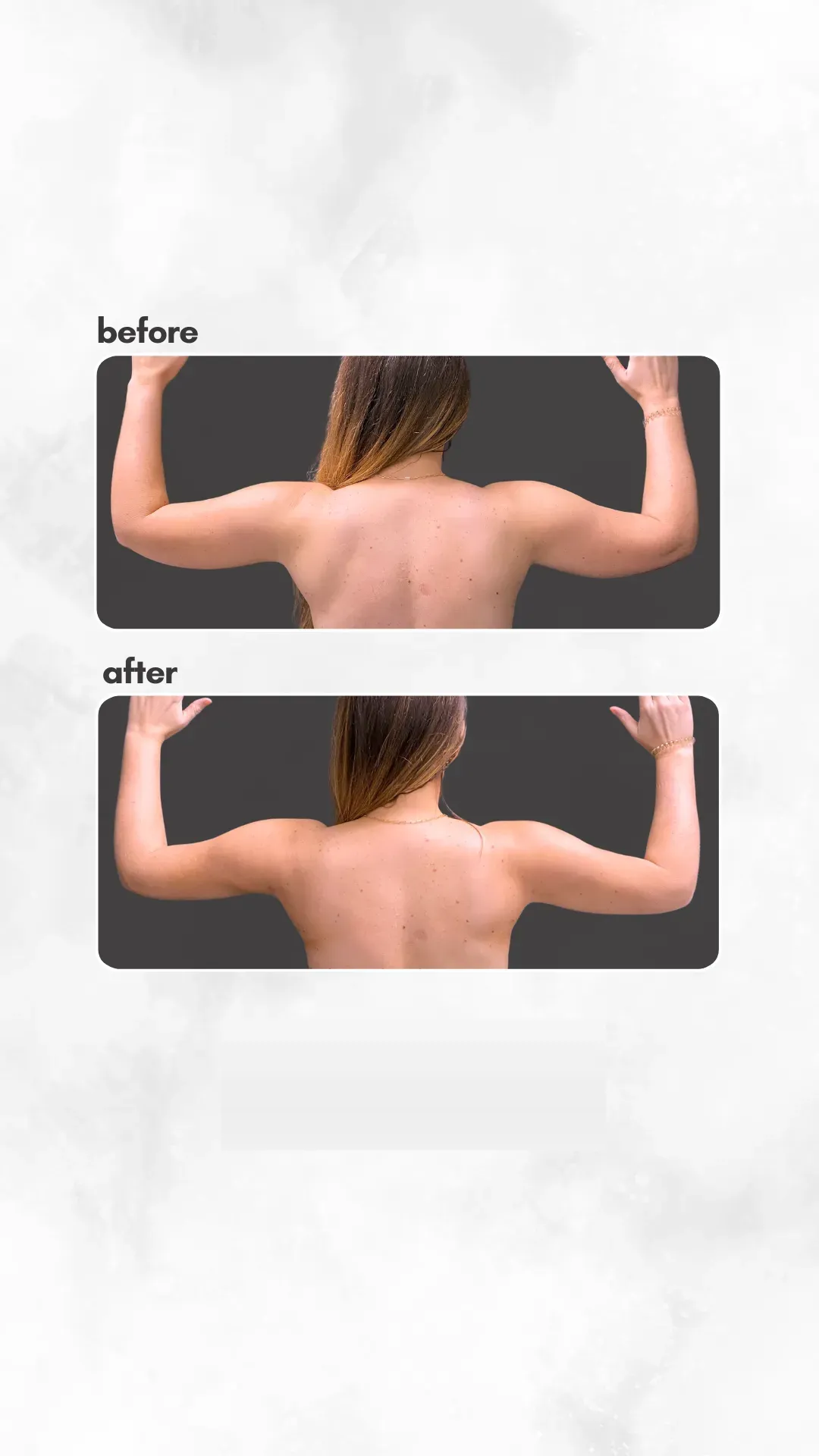 Lipedema before-and-after comparison.