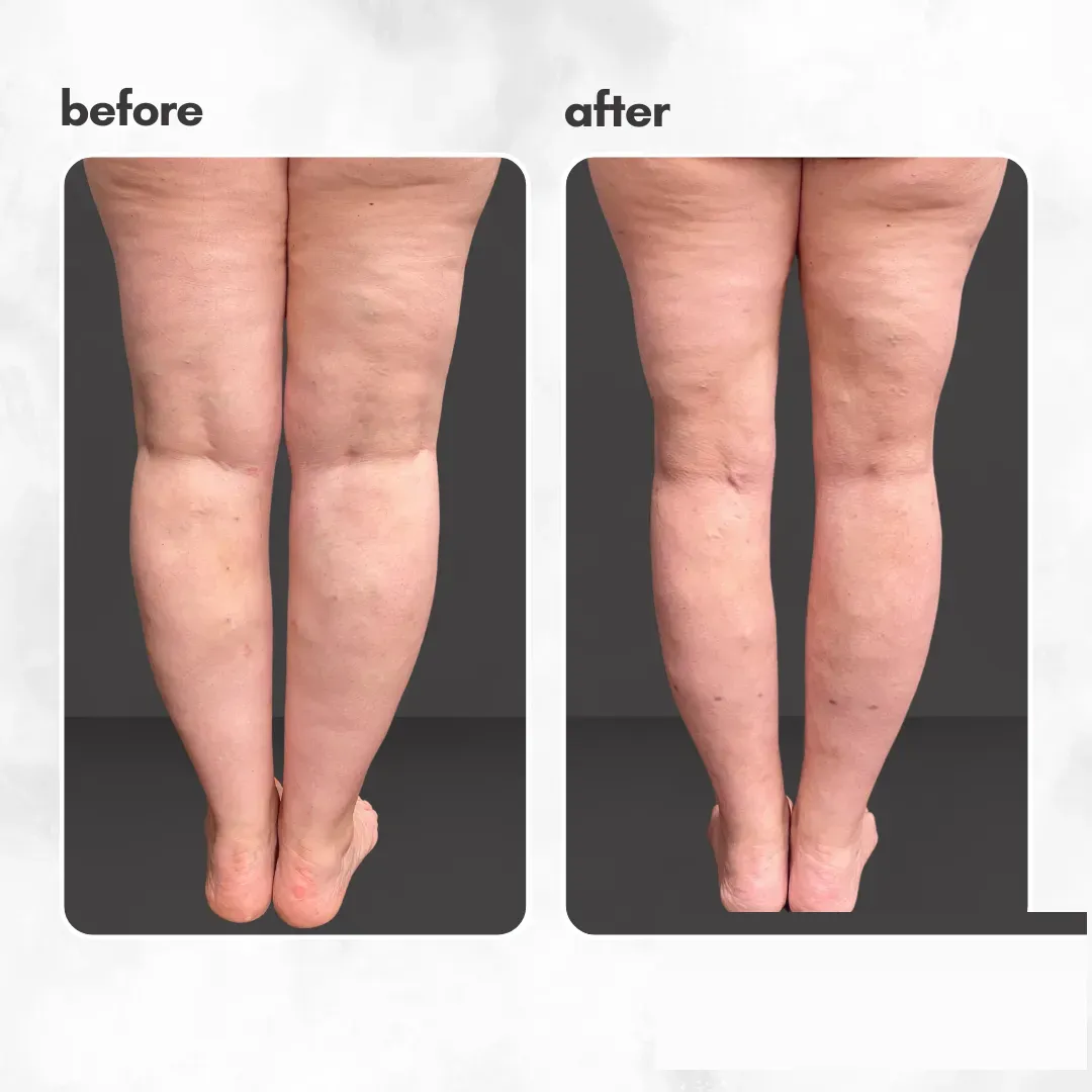 Lipedema before-and-after comparison.