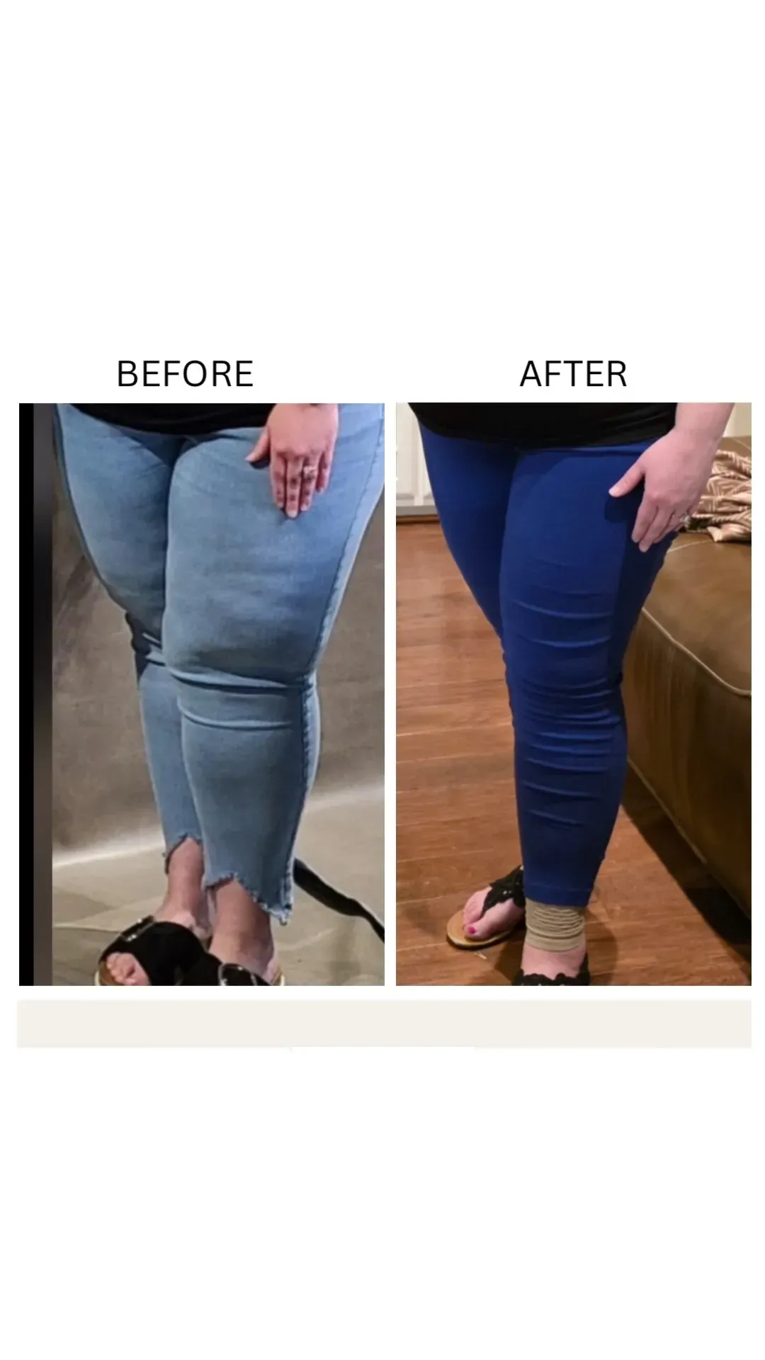 Lipedema before-and-after comparison.