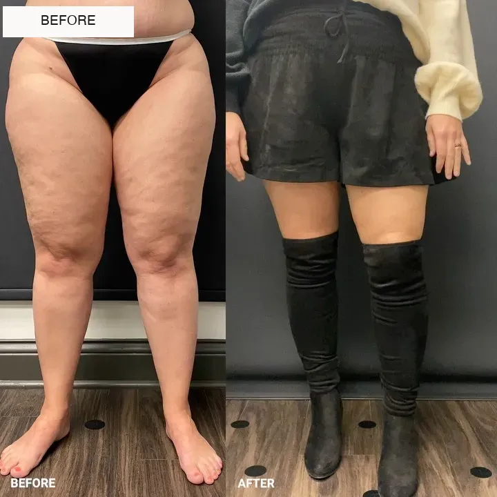 Lipedema before-and-after comparison.
