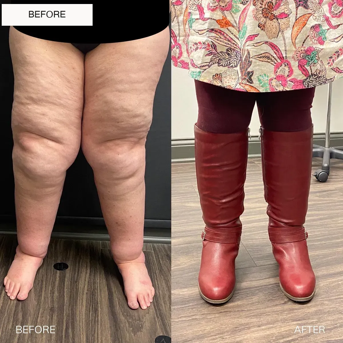 Lipedema before-and-after comparison.