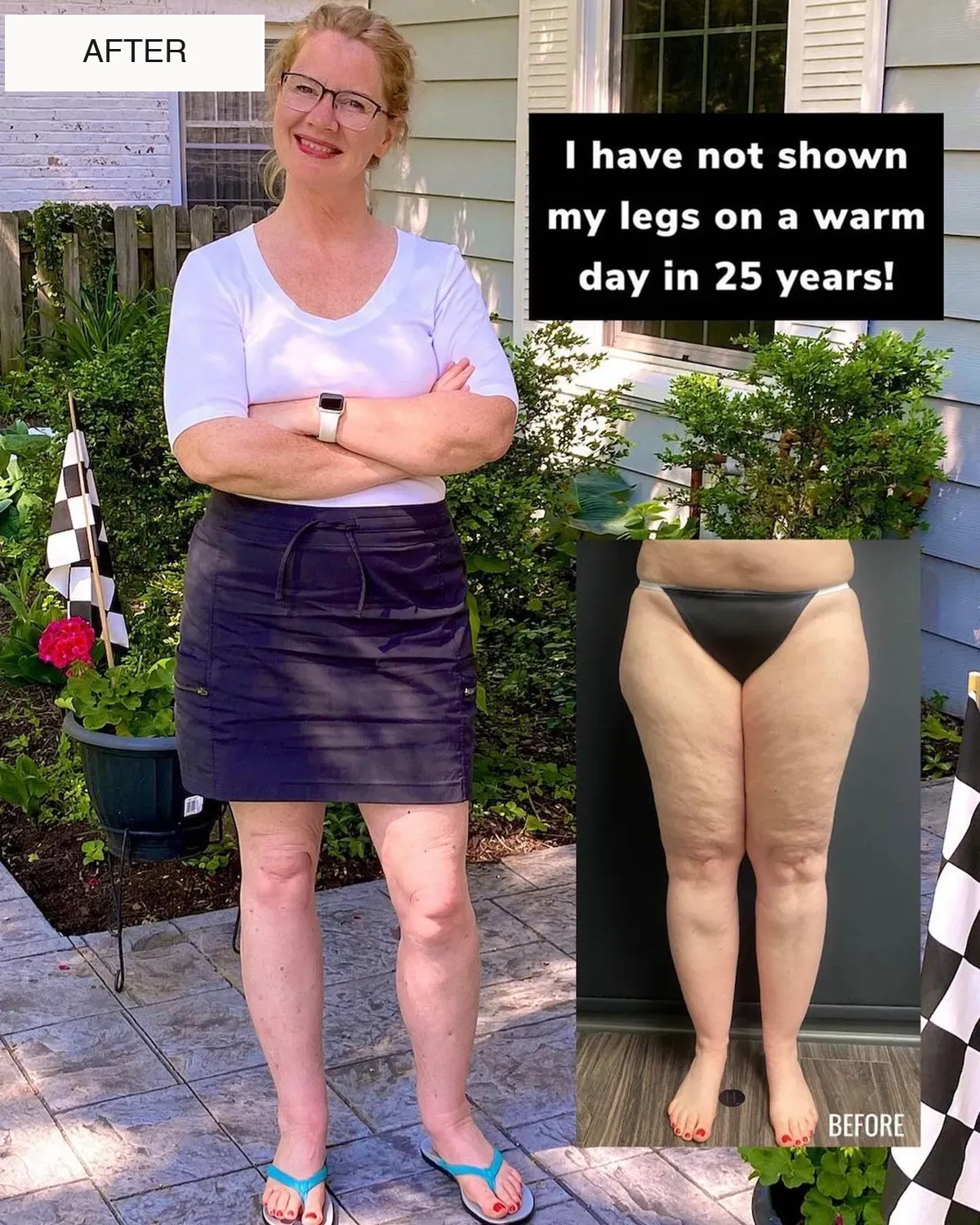 Lipedema before-and-after comparison.