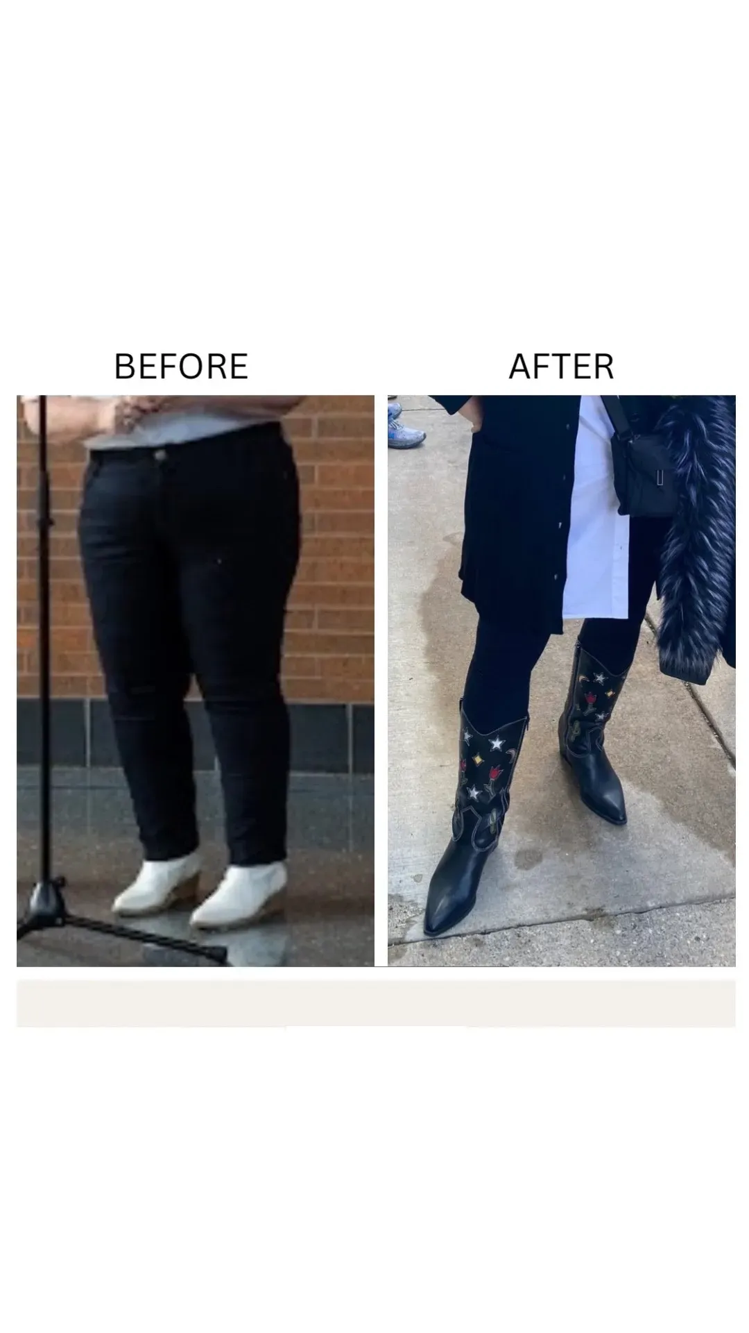 Lipedema before-and-after comparison.