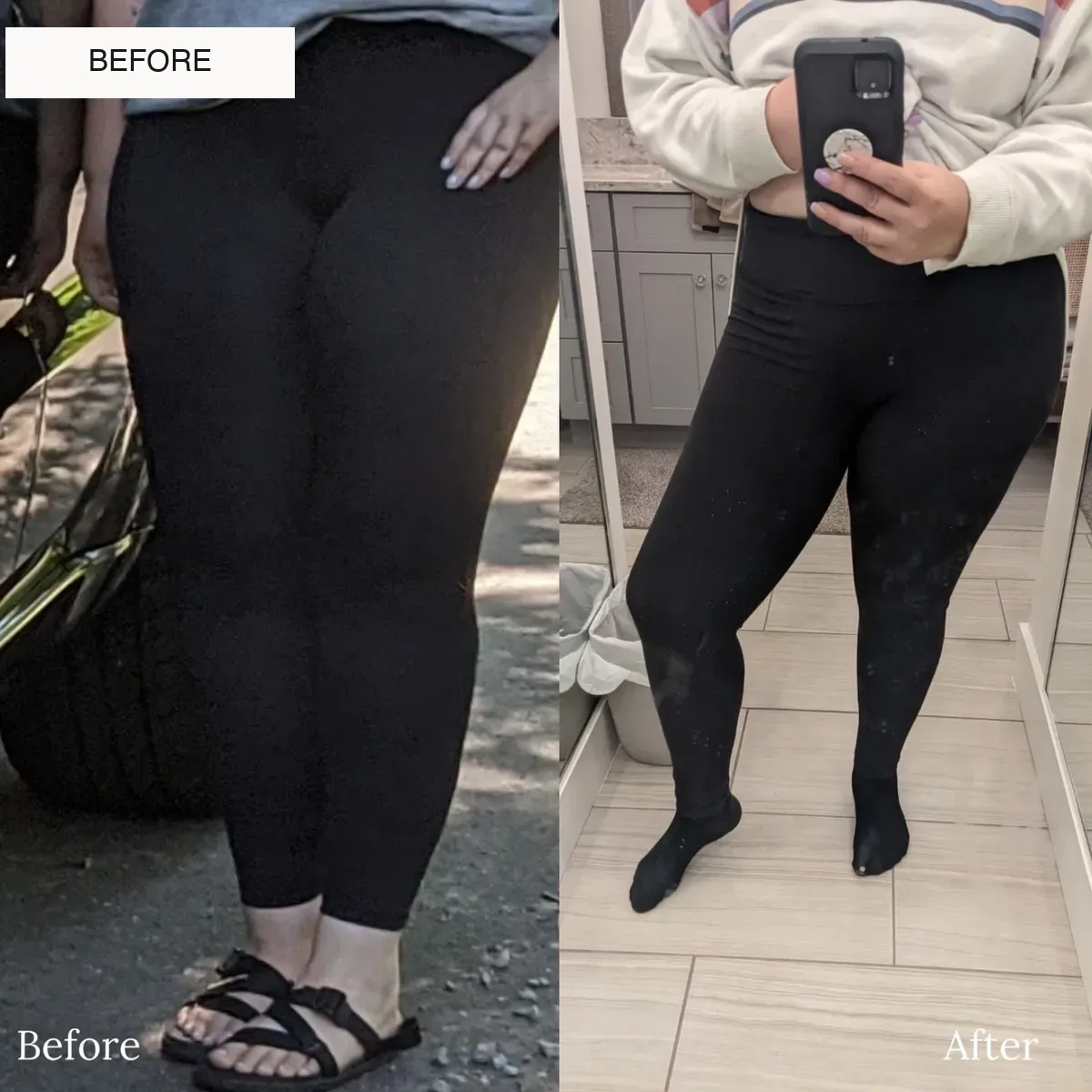 Lipedema before-and-after comparison.