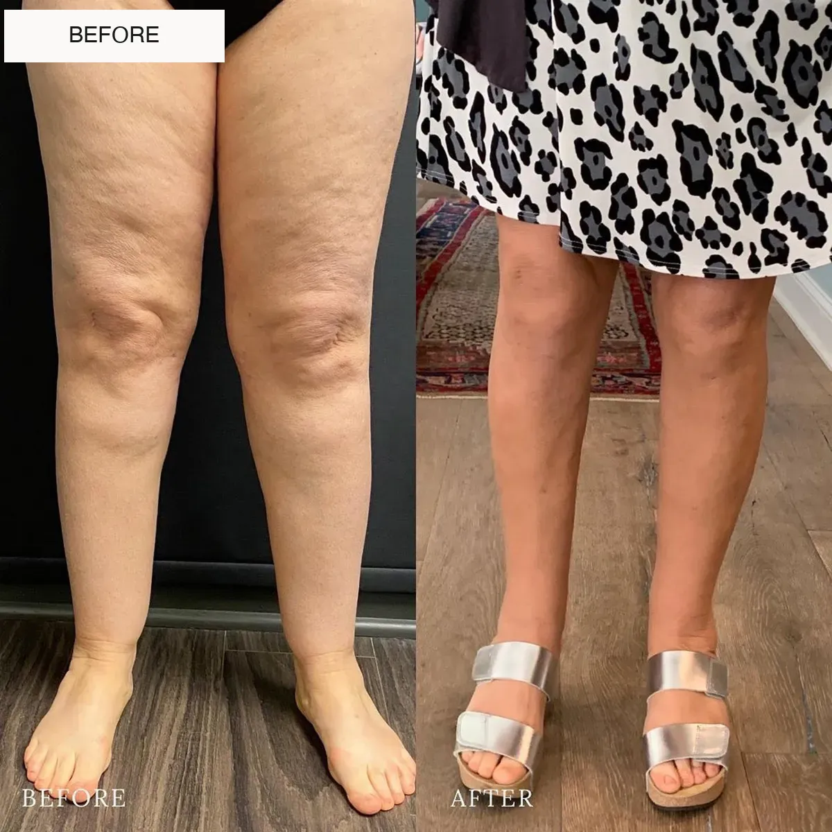 Lipedema before-and-after comparison.