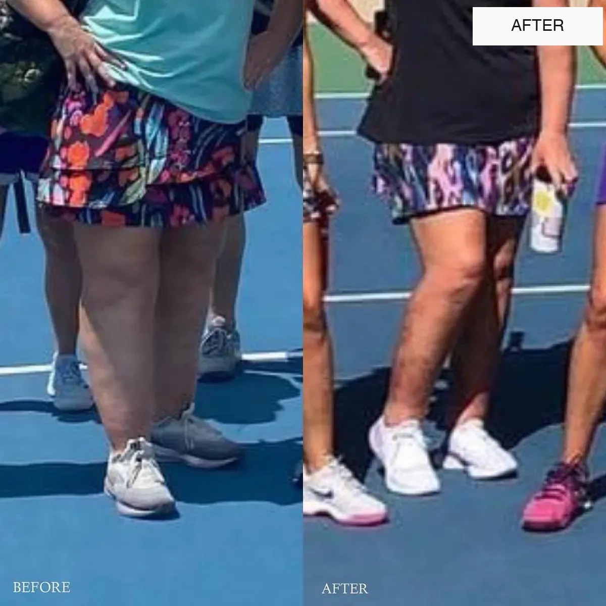 Lipedema before-and-after comparison.