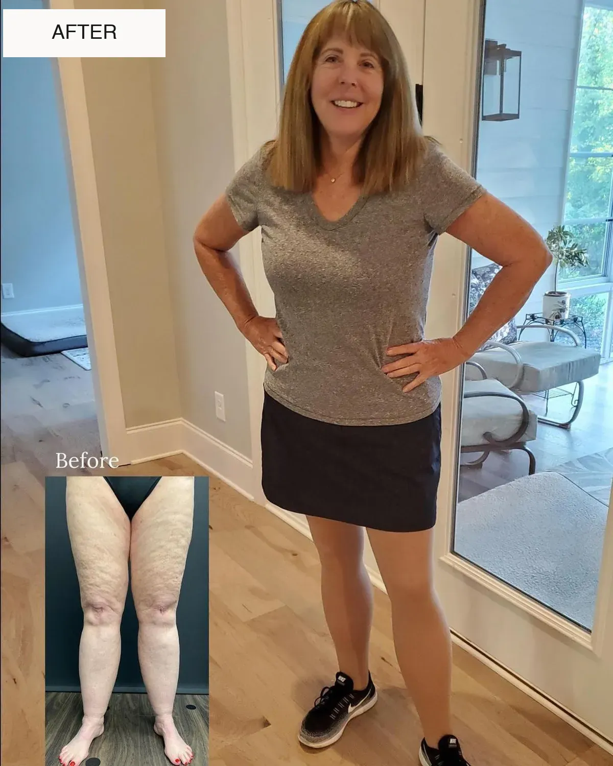 Lipedema before-and-after comparison.