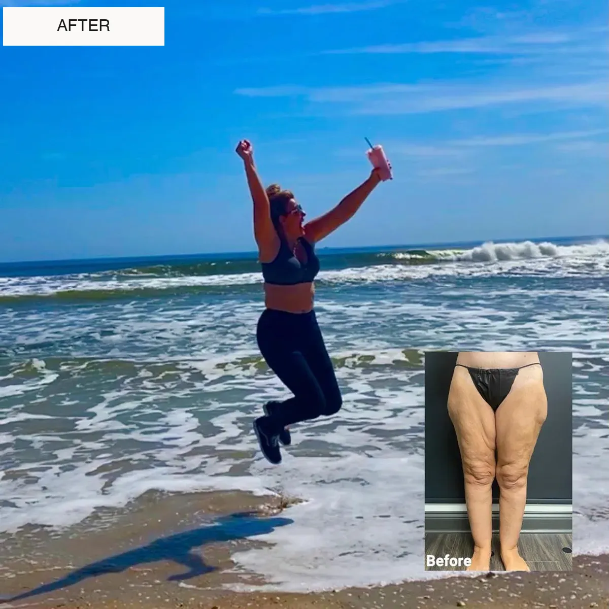 Lipedema before-and-after comparison.