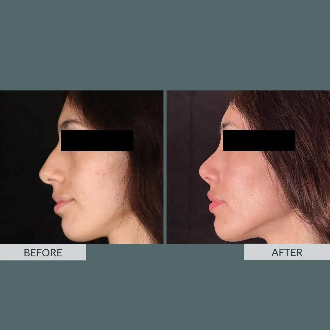 Rhinoplasty before-and-after comparison.