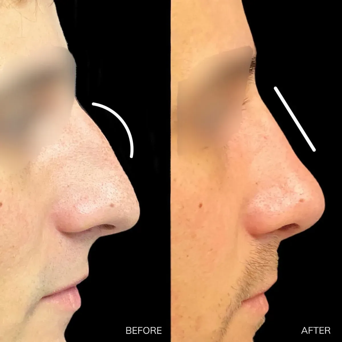 Rhinoplasty before-and-after comparison, 12 weeks after surgery.