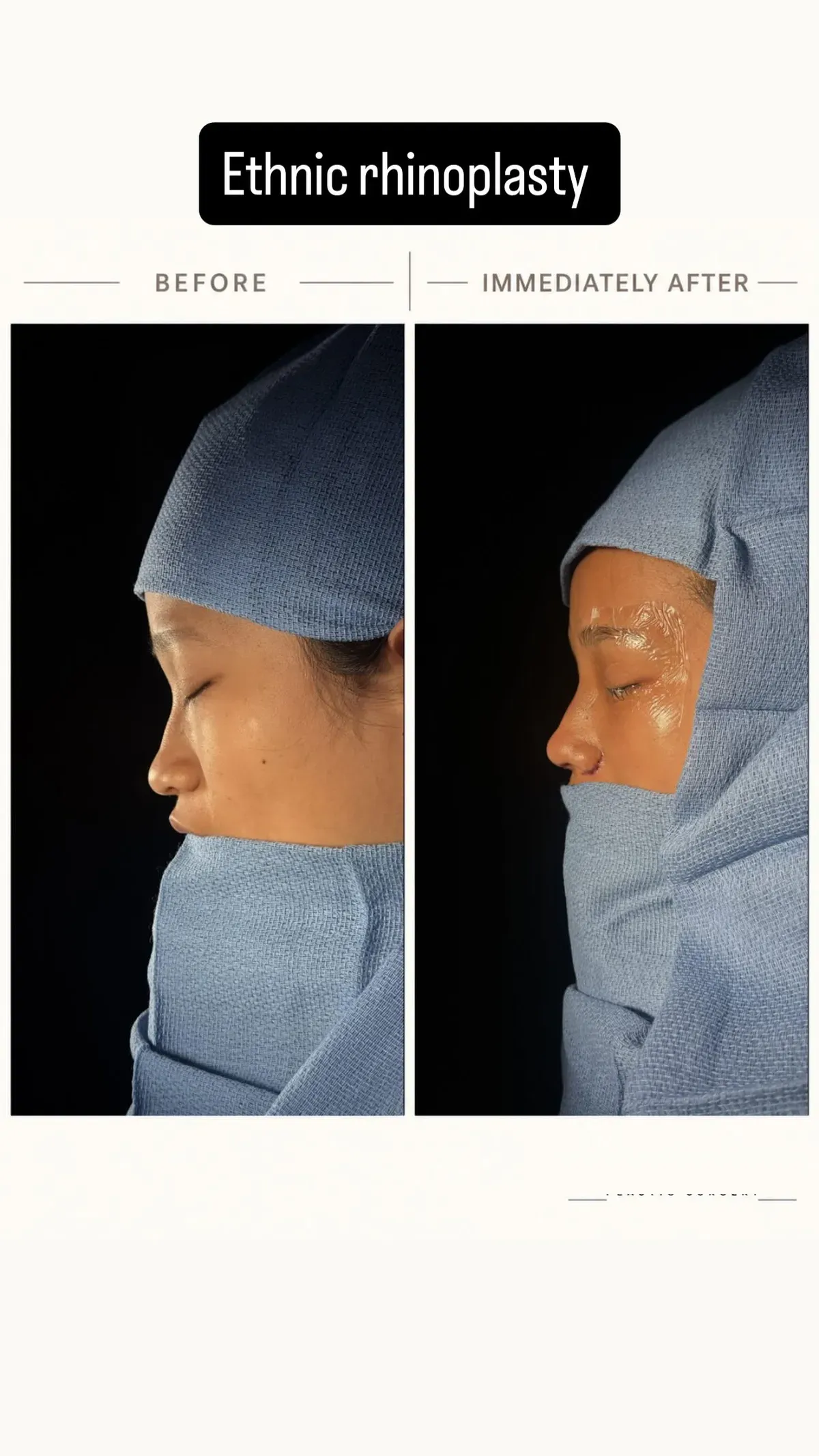 Rhinoplasty before-and-after comparison, immediately after surgery.