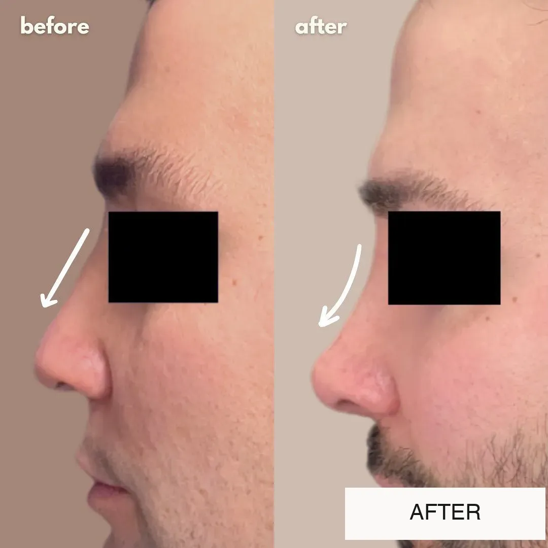 Rhinoplasty before-and-after comparison.