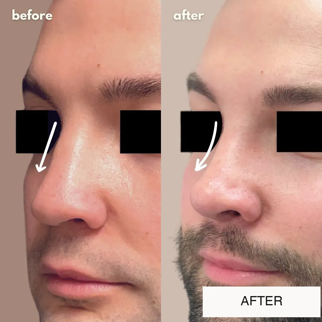Rhinoplasty before-and-after comparison.