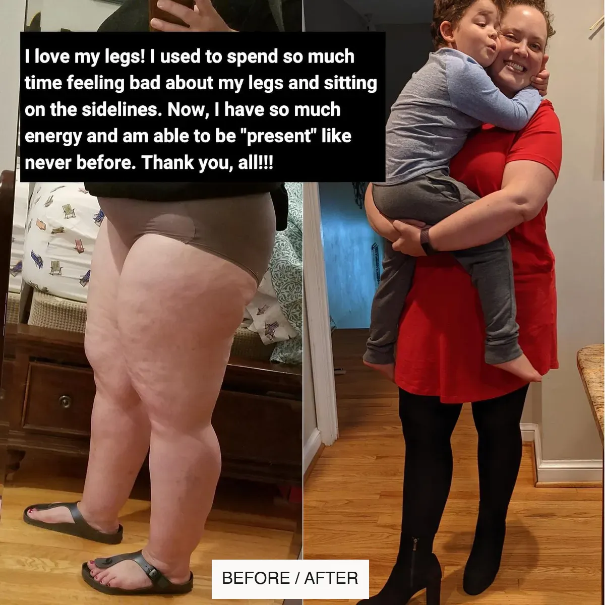 Lipedema before-and-after comparison.
