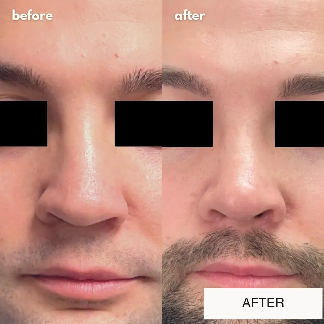 Rhinoplasty before-and-after comparison.