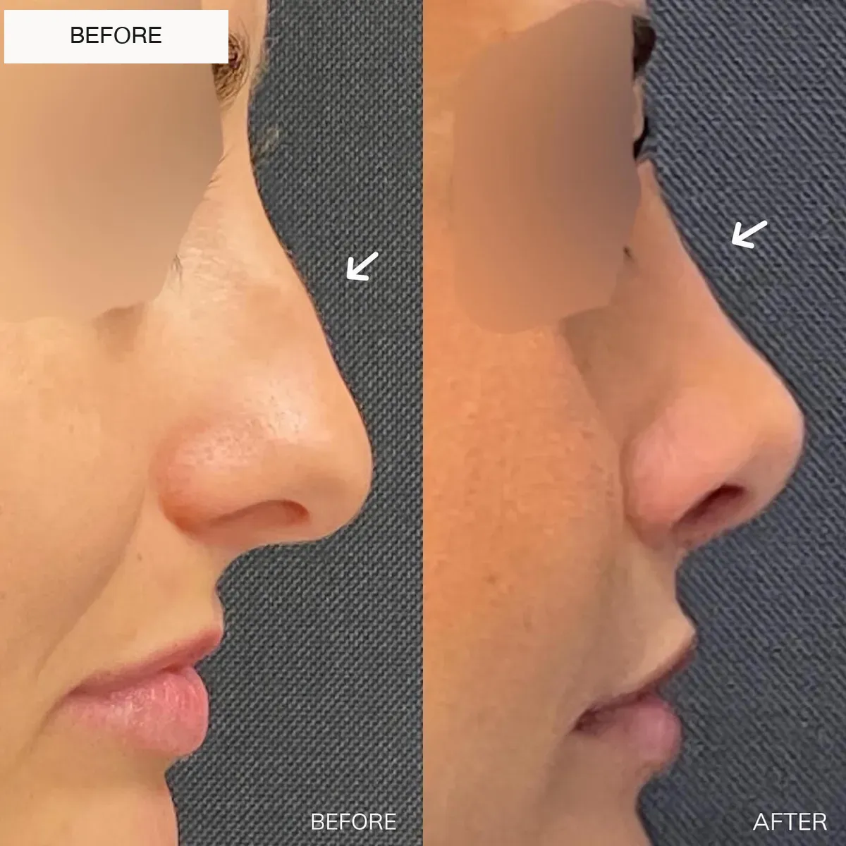 Rhinoplasty before-and-after comparison.