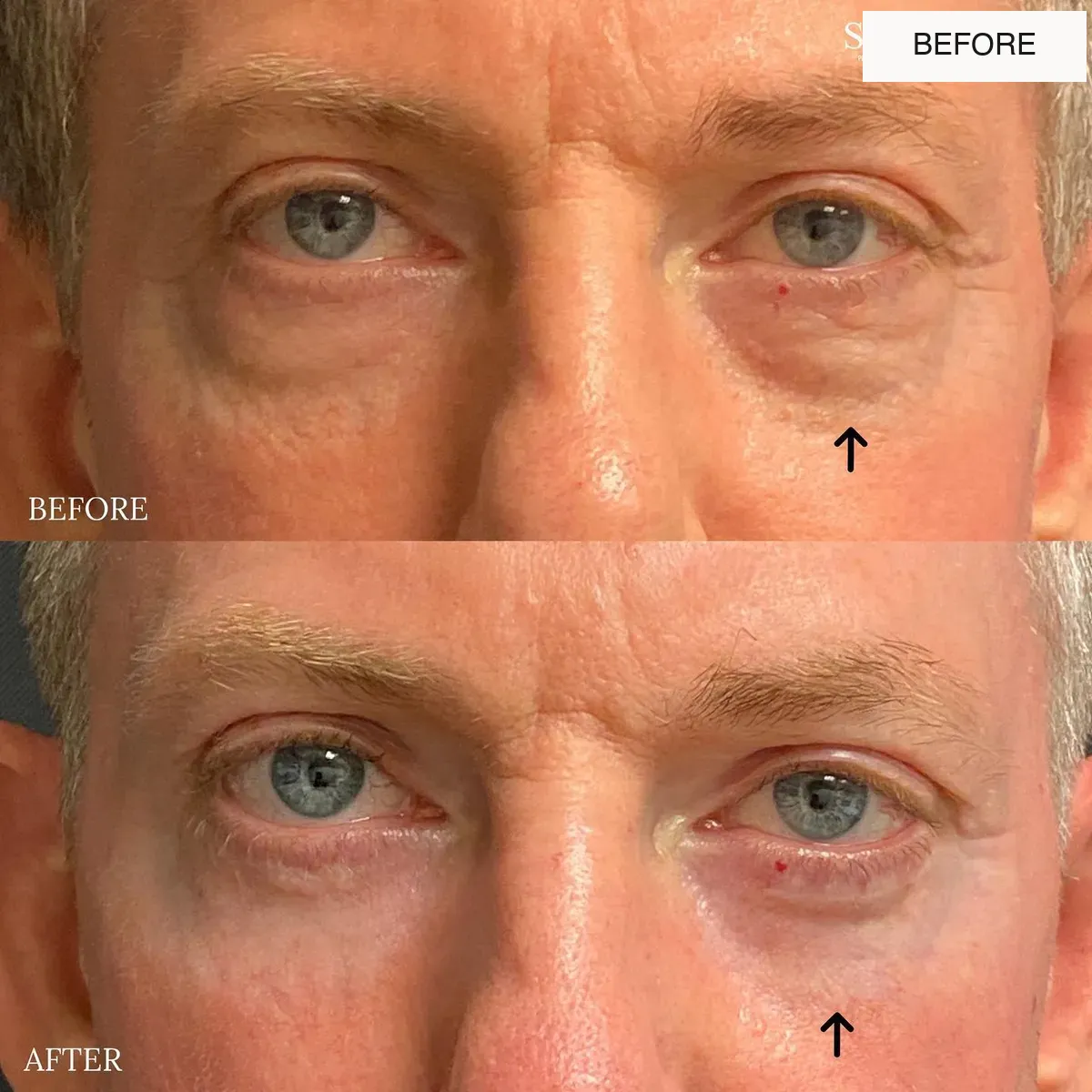 Eyelid surgery before-and-after comparison.