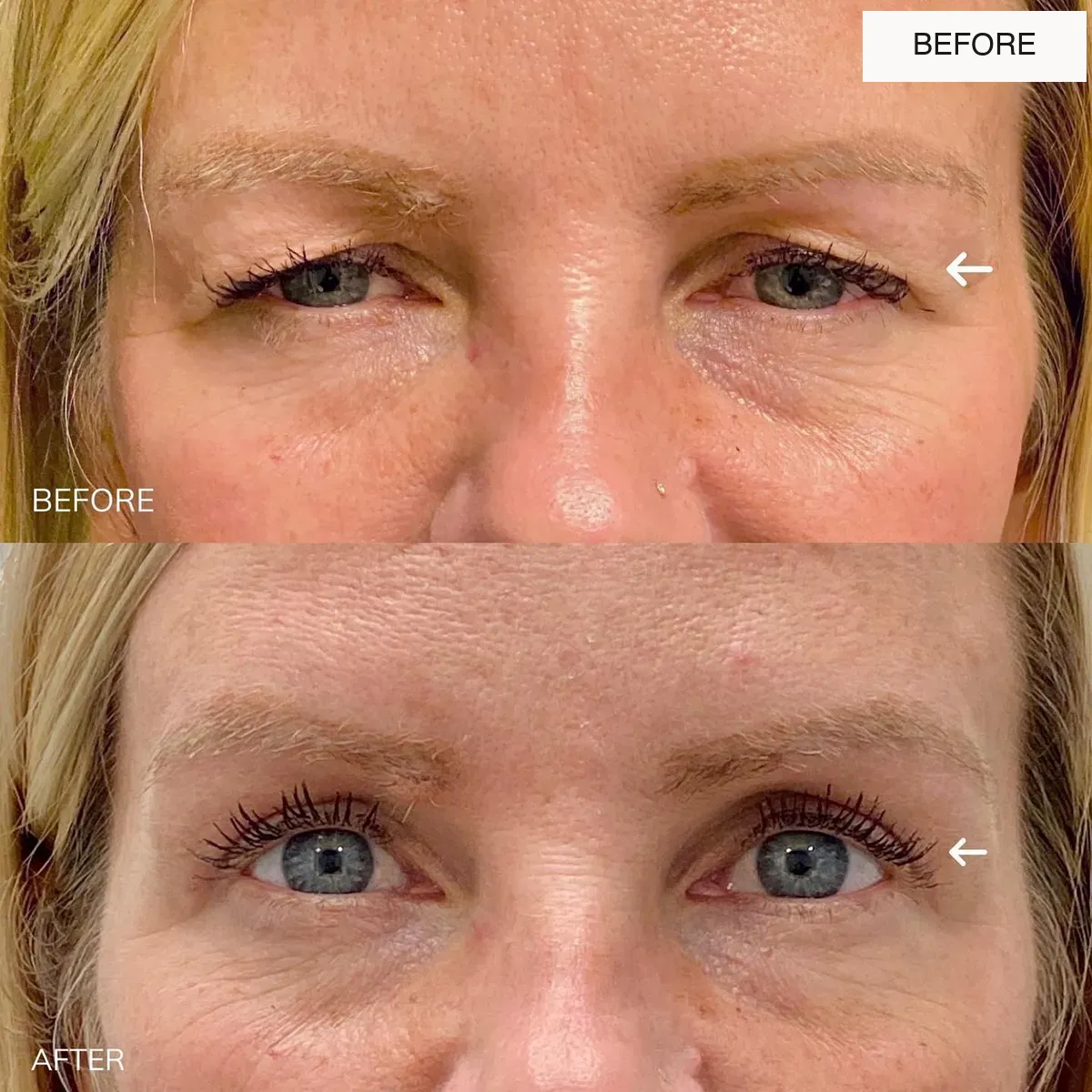 Eyelid surgery before-and-after comparison.