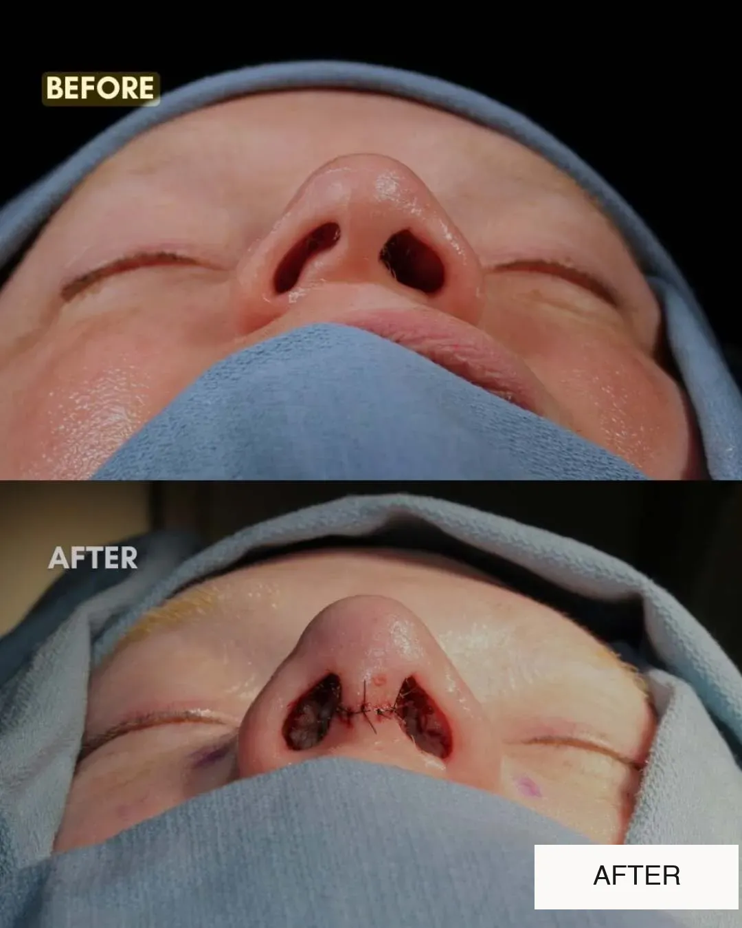 Rhinoplasty before-and-after comparison.