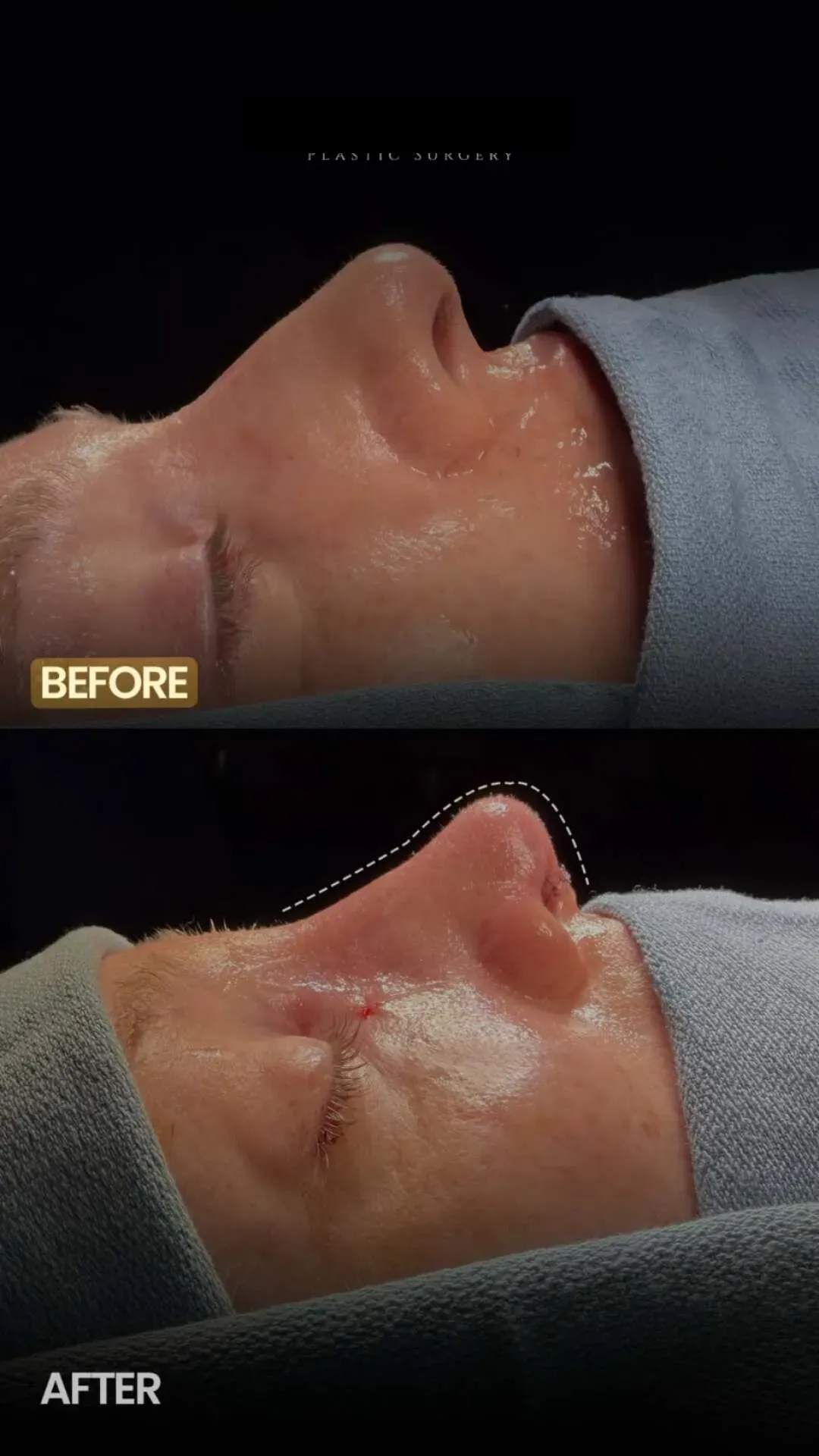 Rhinoplasty before-and-after comparison.