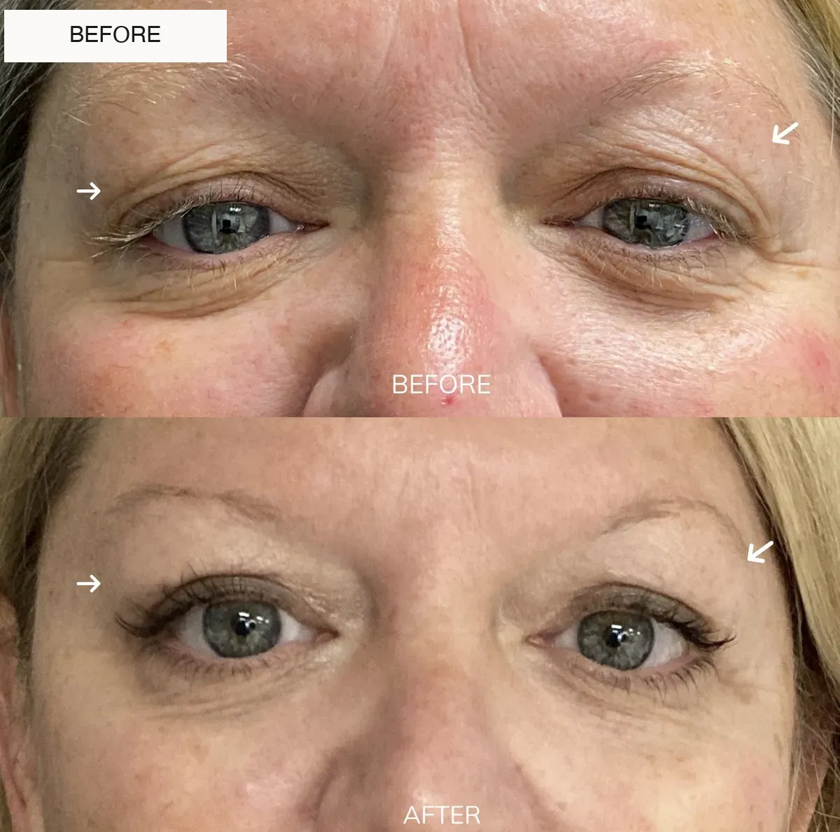 Eyelid surgery before-and-after comparison, front view.
