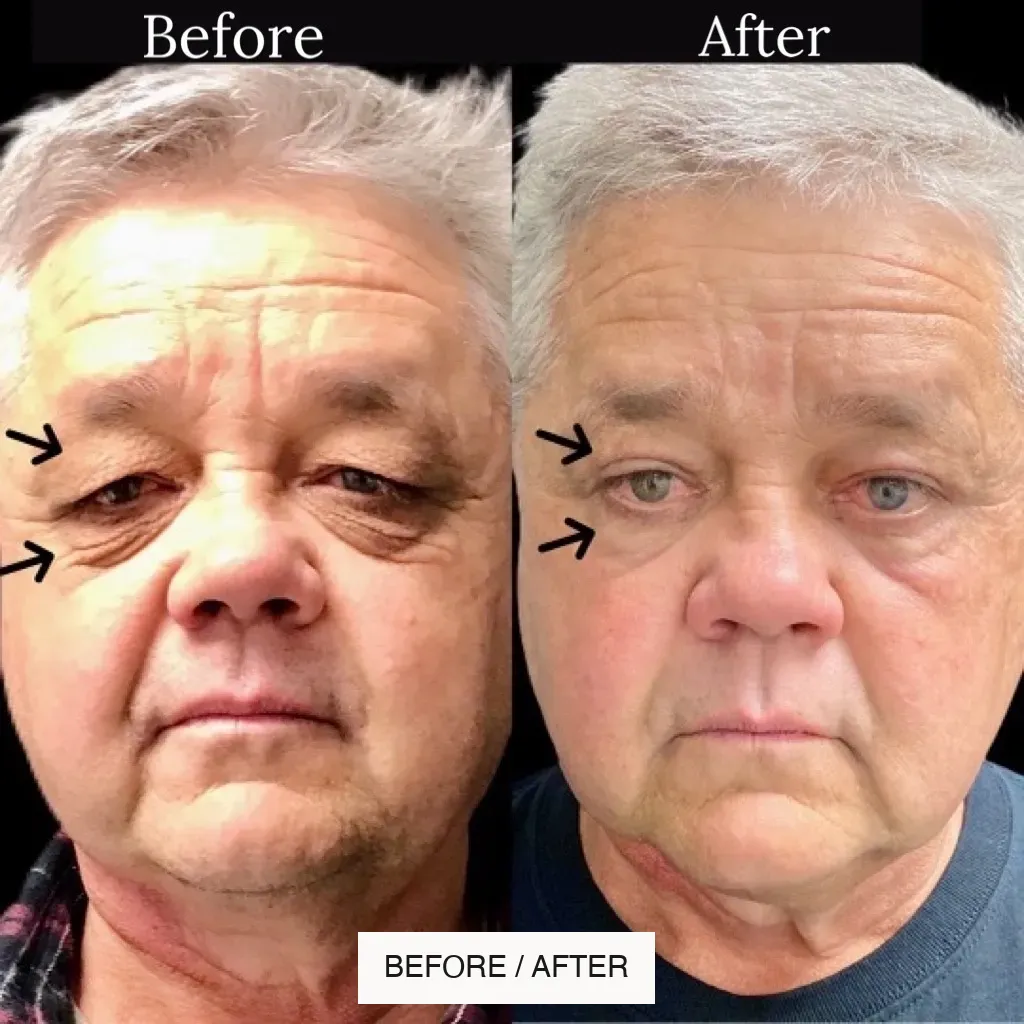 Eyelid surgery before-and-after comparison.