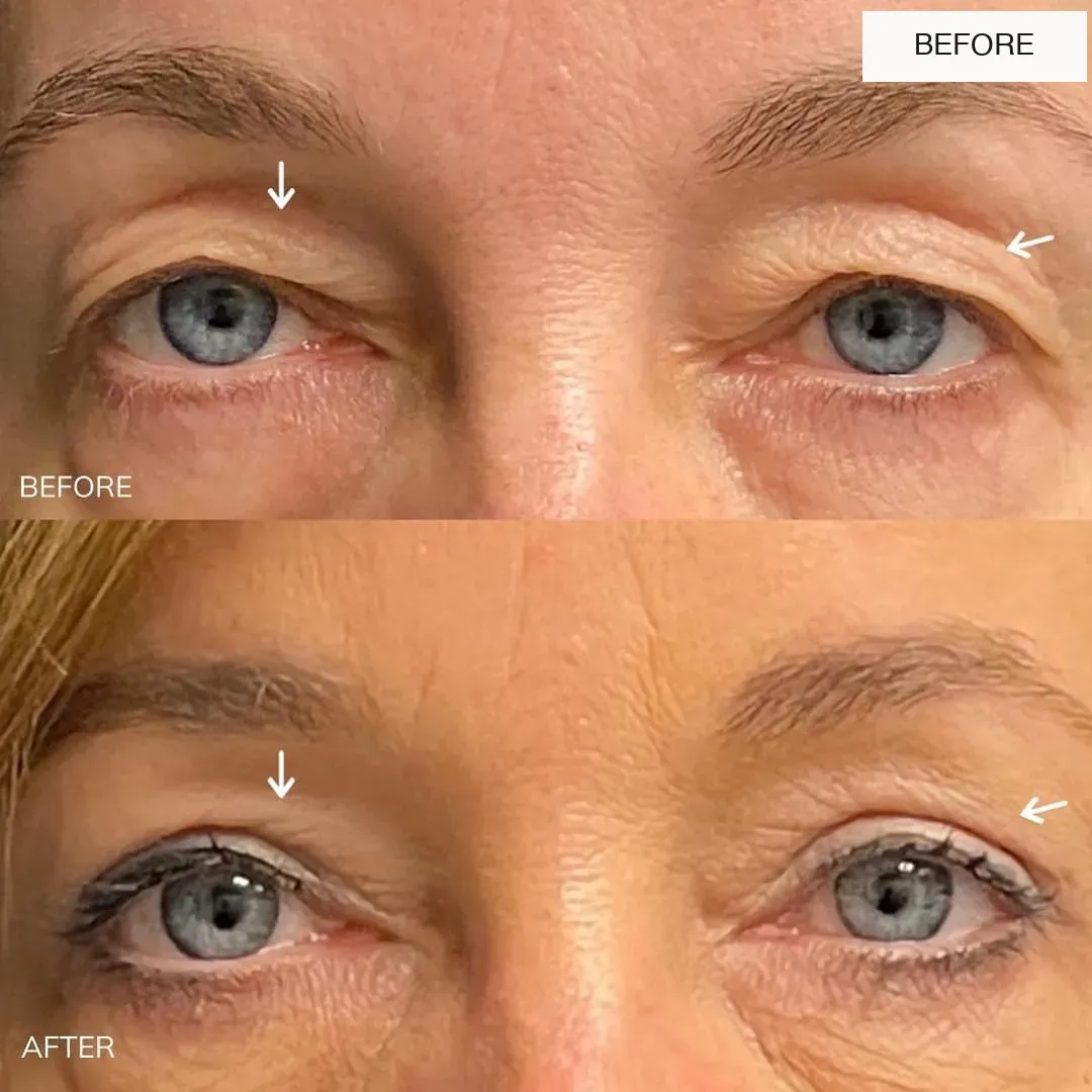Eyelid surgery before-and-after comparison.