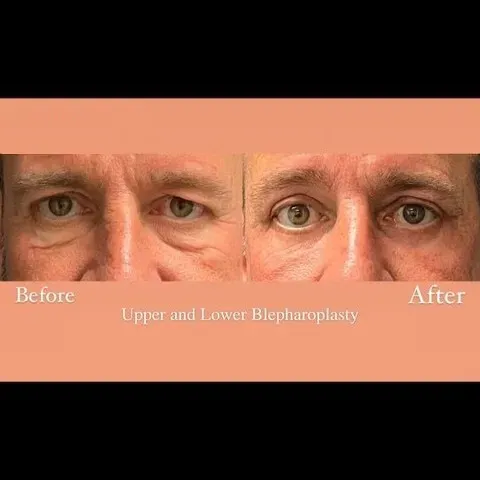 Upper and lower eyelid surgery before-and-after comparison.