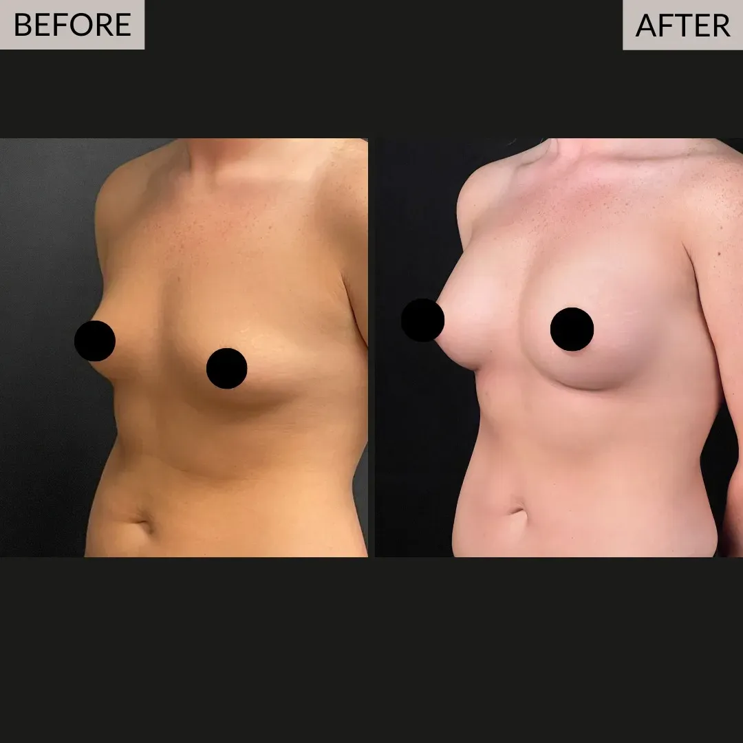 Breast augmentation before-and-after comparison, oblique view.