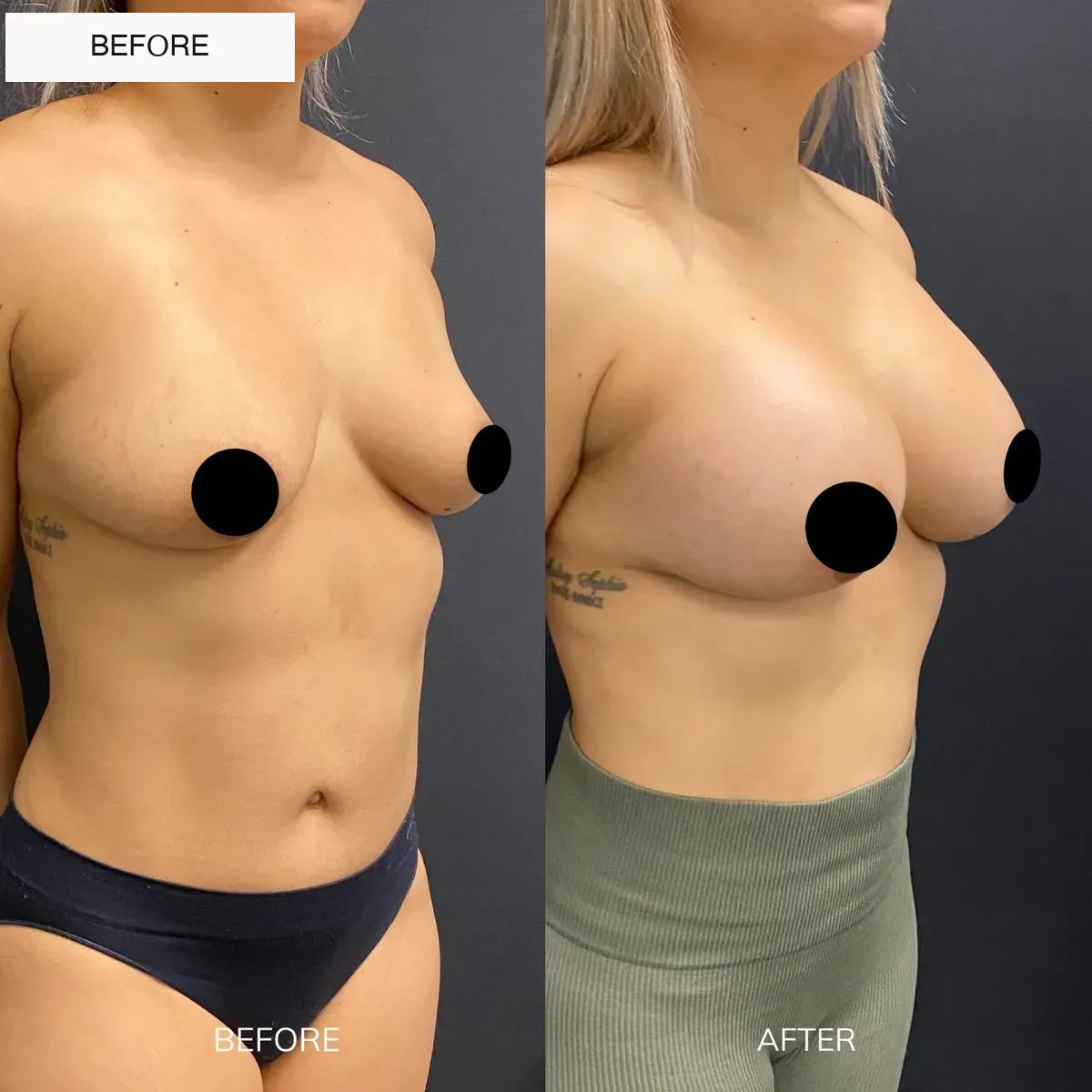 Breast augmentation before-and-after comparison, oblique view.