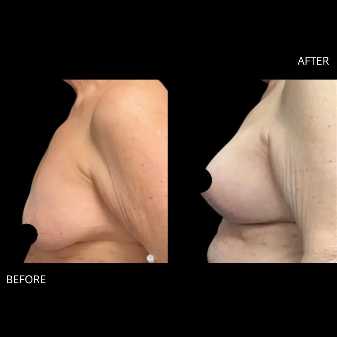 Breast surgery before-and-after comparison.