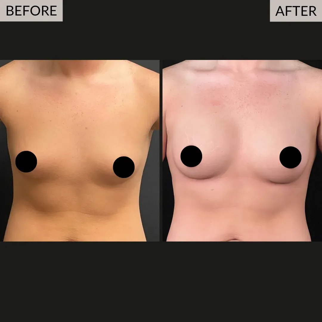 Breast augmentation before-and-after comparison, front view.