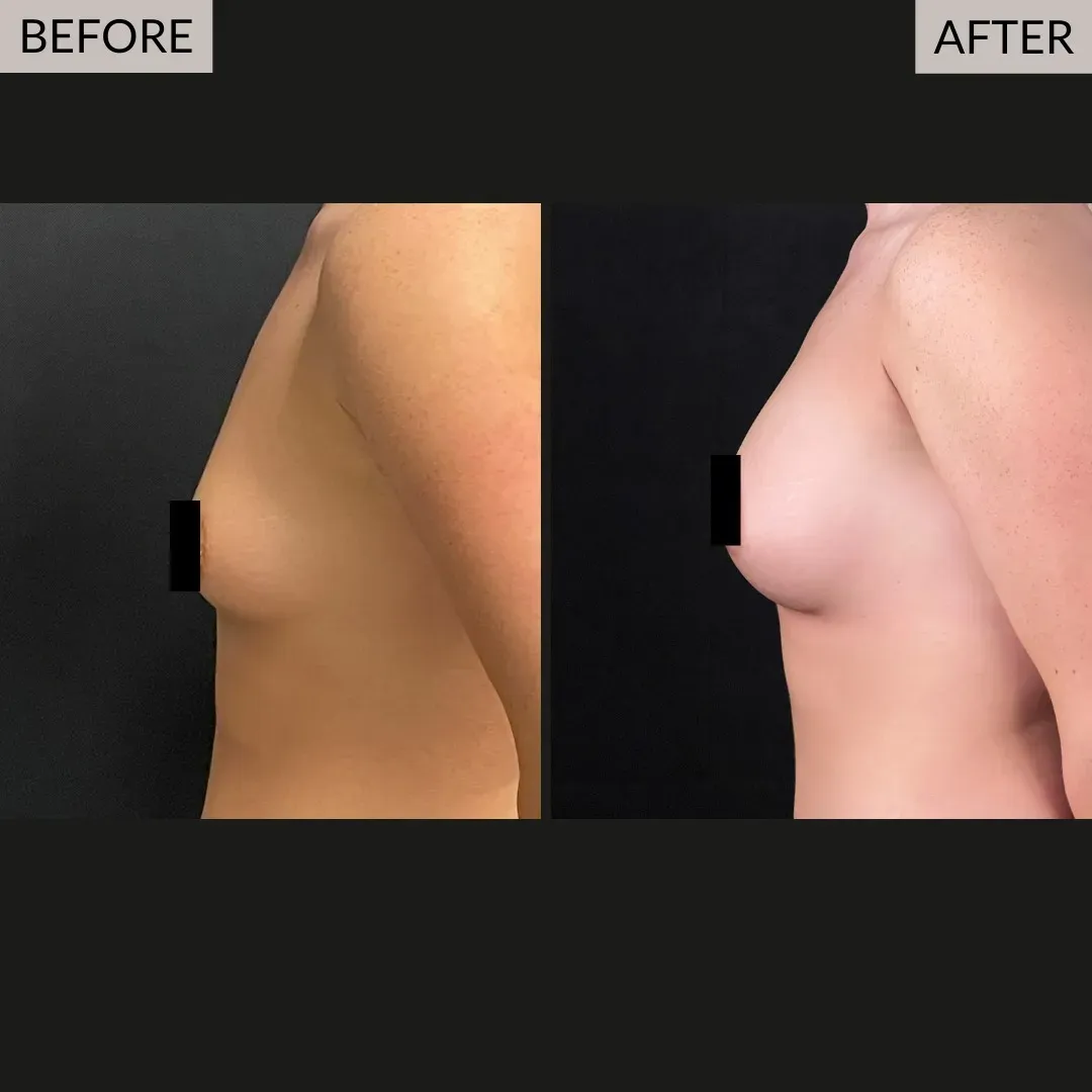 Breast augmentation before-and-after comparison, side view.