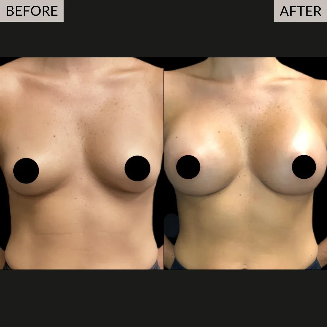 Breast augmentation before-and-after comparison, front view.