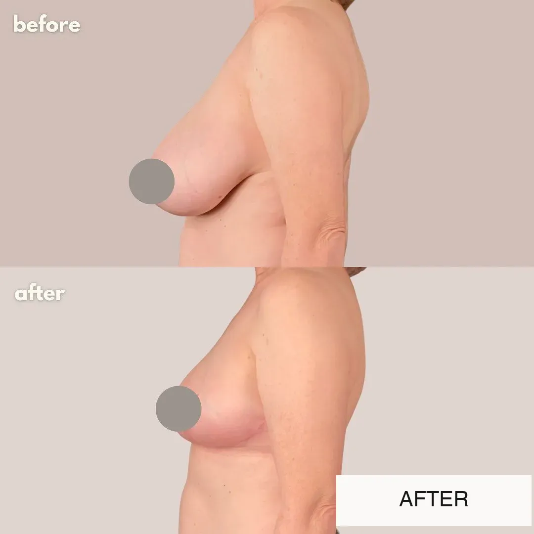 Breast surgery before-and-after comparison.