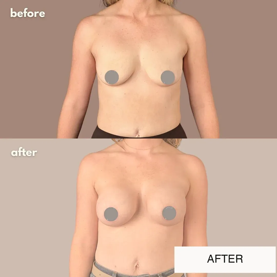 Breast augmentation before-and-after comparison, front view.