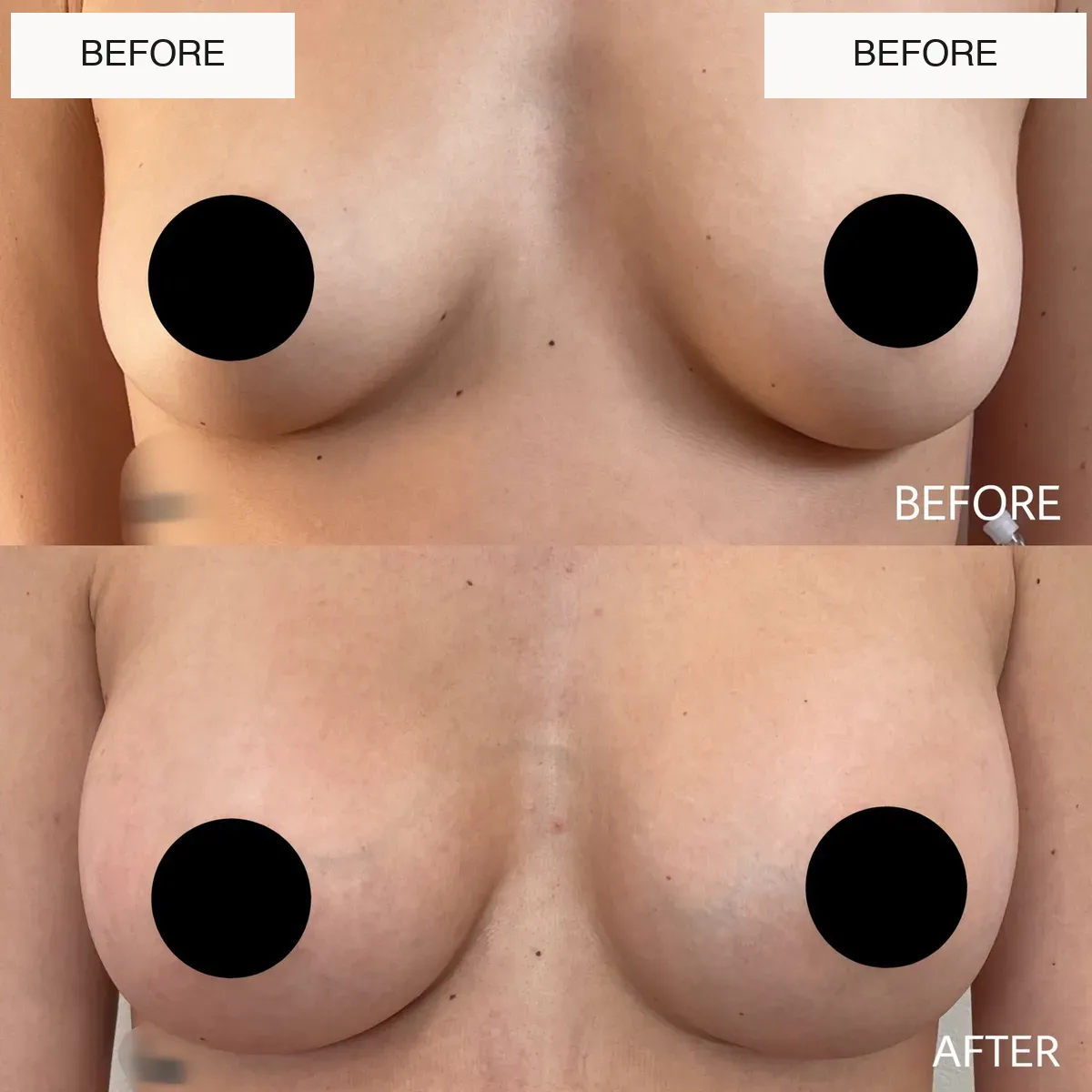Breast surgery before-and-after comparison.