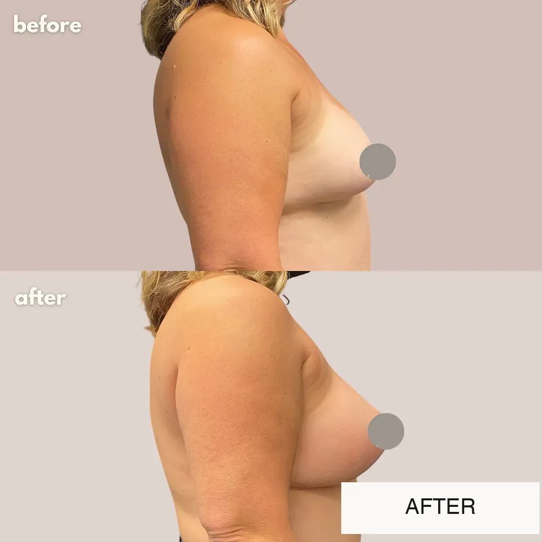 Breast surgery before-and-after comparison.