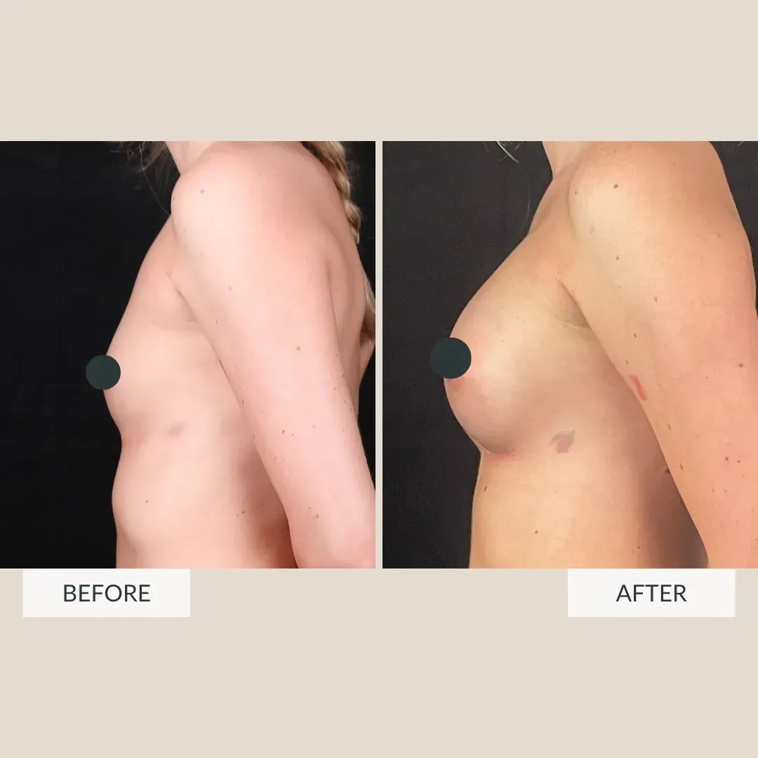 Breast surgery before-and-after comparison.