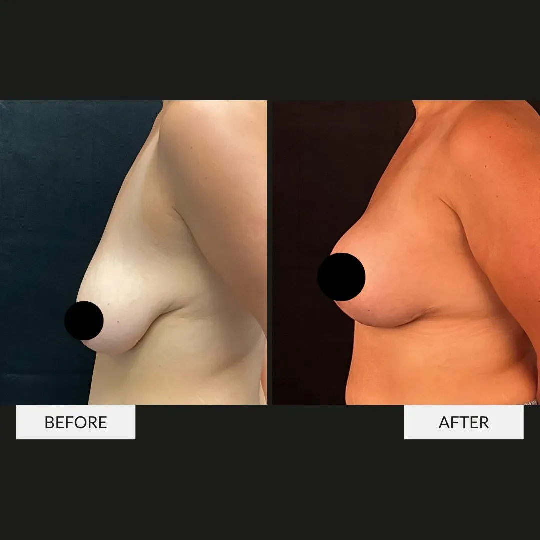 Breast surgery before-and-after comparison.