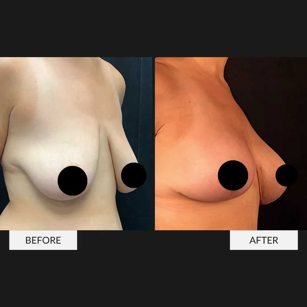 Breast surgery before-and-after comparison.