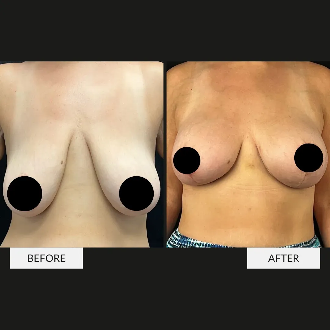 Breast surgery before-and-after comparison.