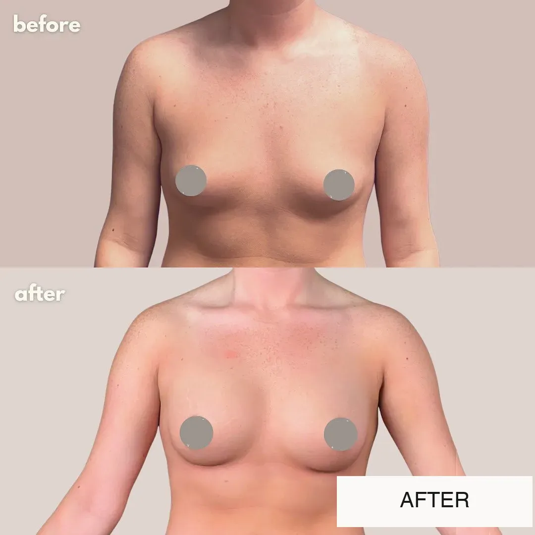 Breast surgery before-and-after comparison.