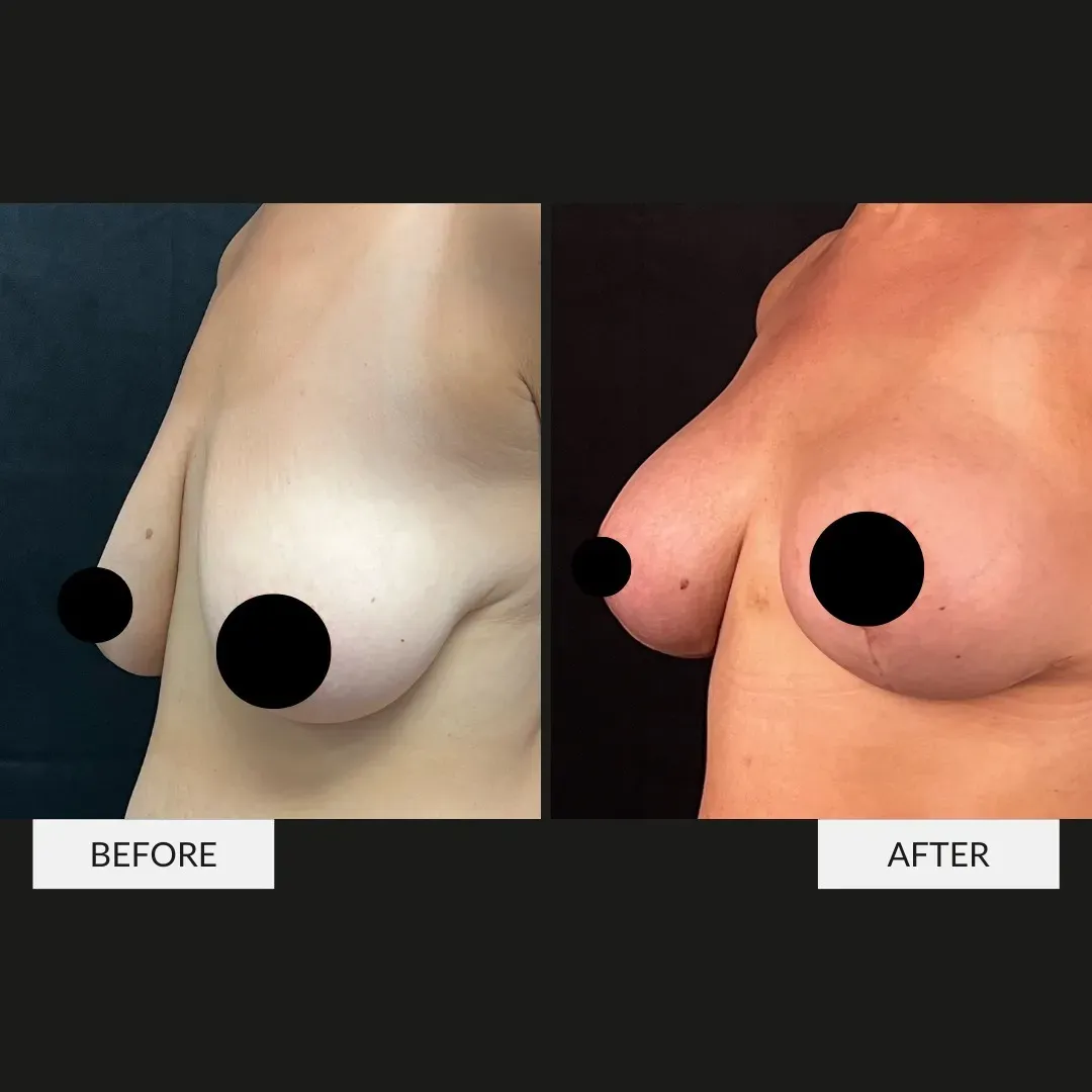 Breast surgery before-and-after comparison.