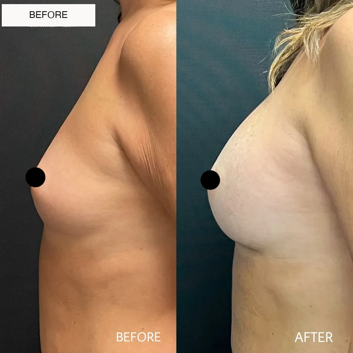 Breast surgery before-and-after comparison.